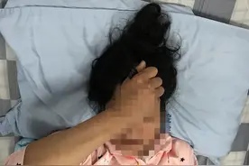 广西一女子剁猪骨时划伤手指，竟患上罕见病，全球仅450例！严重会致死图片