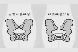孕晚期耻骨痛做盆底肌训练图片