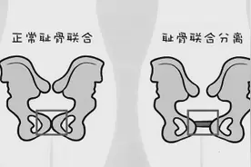 孕晚期耻骨痛做盆底肌训练图片
