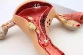子宫肌瘤，是留还是切？图片