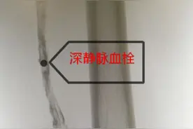 连坐10小时，20岁返校大学生腿肿如象！警惕隐形杀手“经济舱综合征”图片