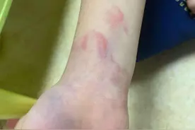 小学生未完成作业手腕被打淤青，涉事教师停职图片