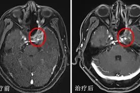 上海重离子治疗新突破：治疗复发鼻咽癌患者两年总生存率达83.7%，成果刊权威期刊图片