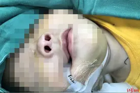 3小时手术打通呼吸的“生命隧道”出生204天，她呼吸到第一口完整空气图片