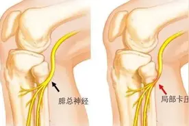 小伙一觉醒来右腿“瘫”了！医生：这个动作很多人喜欢做图片