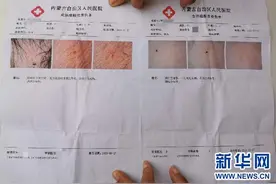 呼和浩特一幼儿园多名孩子身上疑现针眼！三名幼儿园工作人员被刑拘图片