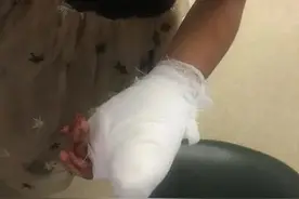 5岁女孩拇指被门夹断！浙江妈妈做对这一步，手指保住了图片