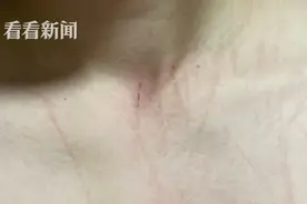 宠物猫买回当天主人被抓几十道伤口 宠物店：管不了图片