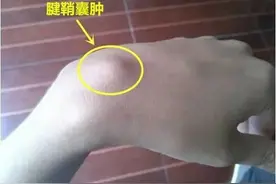 腱鞘囊肿，怎么处理好？会癌变吗？图片