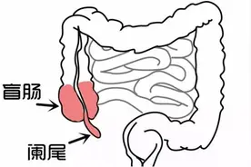 人人都可能遇上的阑尾炎，竟有致命危险！早识别、会预防，护好阑尾，也能增强免疫力图片