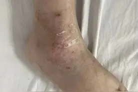 10岁女童膝盖肿胀如“馒头”，竟是幼年特发性关节炎图片