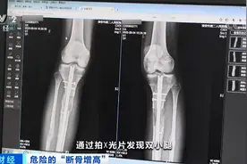 因身材自卑，他赴韩国“断骨增高”！严重感染，或终身残疾...穿透双腿的钢针，是增高器还是凶器？图片