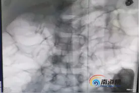 三亚6岁男孩腹痛一个多月 医生从他胃里取出31颗磁力珠图片