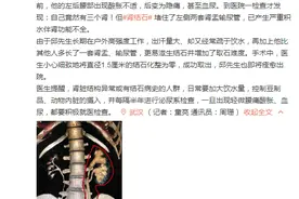 男子天生三个肾 却被小结石撂倒图片