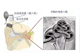 中山七院耳鼻咽喉科成功完成第一例人工耳蜗植入手术图片