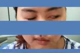 一旦遭“面瘫”这辈子就完了？！华西医生说治疗方法那么多，不医才完了！图片