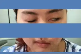 一旦遭“面瘫”这辈子就完了？！华西医生说治疗方法那么多，不医才完了！图片