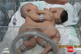 “连心”女婴10年前华西医院“分身”如今她们健康长大重见救命恩人图片
