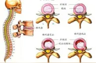 【体育保健康复专委会】腰椎间盘突出的运动与康复图片