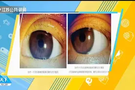 头皮发麻！种假睫毛不注意，姑娘睫毛根长满螨虫，睫毛都快掉光了视频封面