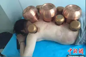 蒙医铜罐疗法科技成果转化：造福更多百姓图片