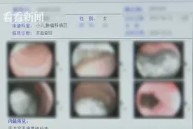 女孩全身没血色 一查发现胃里竟有个“钢丝球”图片