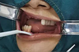 缺牙掉齿难咀嚼 修复技术解烦忧图片