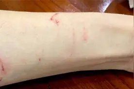 酒店洗完澡玻璃门突然爆裂，碎渣像雨落下，她全身20多处被划伤视频封面
