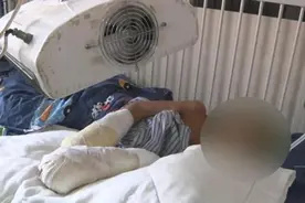 7岁男童疑遭父亲烟头烫满身伤疤，医生：若幸运可不截肢图片