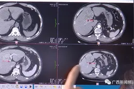 广西一男子享用鱼生32年，胆管中发现大量肝吸虫，最大堪比瓜子仁儿图片