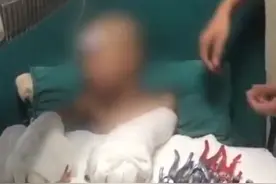 被父亲烧伤男孩称常被爸妈打：想与爷爷奶奶住图片