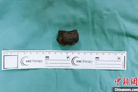 成都一老人长期空腹吃大量柿子 严重胃结石险丢性命图片