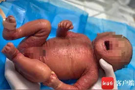 海南一宝宝出生全身为羊皮纸样 是罕见的“火棉胶婴儿”图片