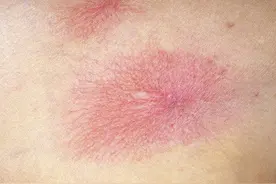网帖让她怀疑自己患上乙肝 医生：身现这种红痣请到医院做检查图片