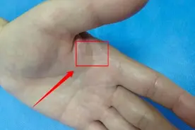 长沙男子钓鱼时鱼钩倒刺扎进手掌，专家：强行拔出后果不堪设想图片