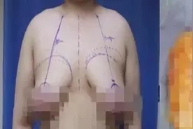 大四男生竟然长出C罩杯！杭州这家医院专为男人准备的这张床从未空过图片