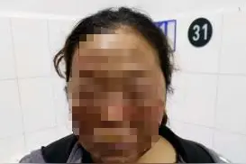 一声巨响，贵阳一老人脸被烧伤图片
