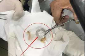 惊险！11个月大婴儿误吞锐利金属盖险致命！救治过程曲折图片
