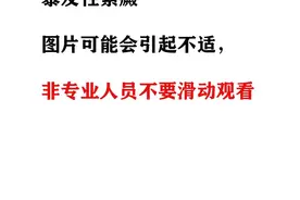 表现为暴发性紫癜的Mowat-Wilson综合征图片