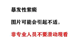 表现为暴发性紫癜的Mowat-Wilson综合征图片