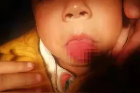 4岁女童幼儿园摔倒致舌头撕裂伤 家长质疑园方安全监管不到位，索赔9万图片