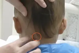 画面太揪心！20多厘米筷子贯穿2岁幼儿喉部...视频封面