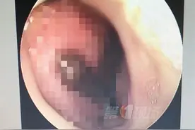 女子鼻腔取出活水蛭！只因她做了这件事图片