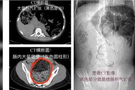 高二女生腹痛难忍寻医，一次排出8斤……马桶都堵了图片