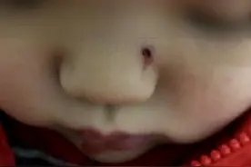 孩子送到早教班，鼻子被老师指甲戳伤，家长崩溃：这是半年内第6次受伤了图片