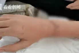 “不后悔！”18岁学生挡刀救人手腕肌腱被砍 艺考就在眼前图片