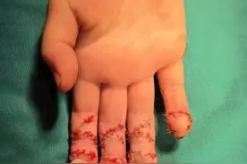 看着都疼！小女孩将手伸进绞肉机，结果……妈妈急哭图片