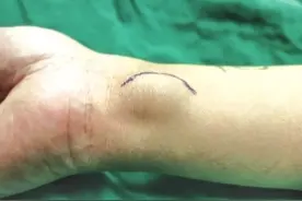 福州一男子手腕长个“鹌鹑蛋”一碰手指就麻图片
