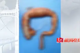 22岁女孩30天才上一次大号，医生从其腹中取出重达20斤病变肠子图片