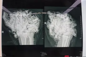 将手指“寄养”在脚背上 三合板式拼装为工伤青年重建手掌图片